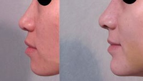 垫下巴整容多少钱