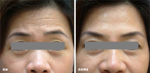 自体脂肪去抬头纹效果好不好