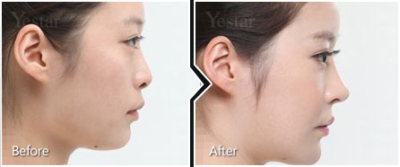 塌鼻整形对比种草