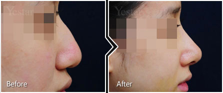 驼峰鼻整形对比种草