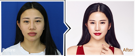 鹰钩鼻整形对比种草