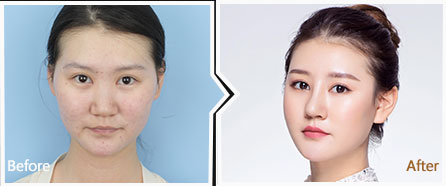 鼻翼缩小对比种草