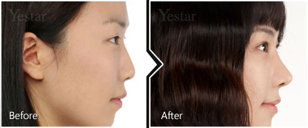 短鼻整形对比种草