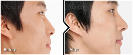 鼻头整形对比种草