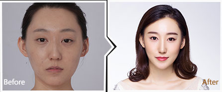 鼻头整形对比种草